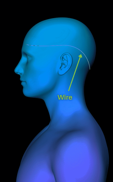 Postural Reed The Reed Procedure® - Migraine Treatment & Relief