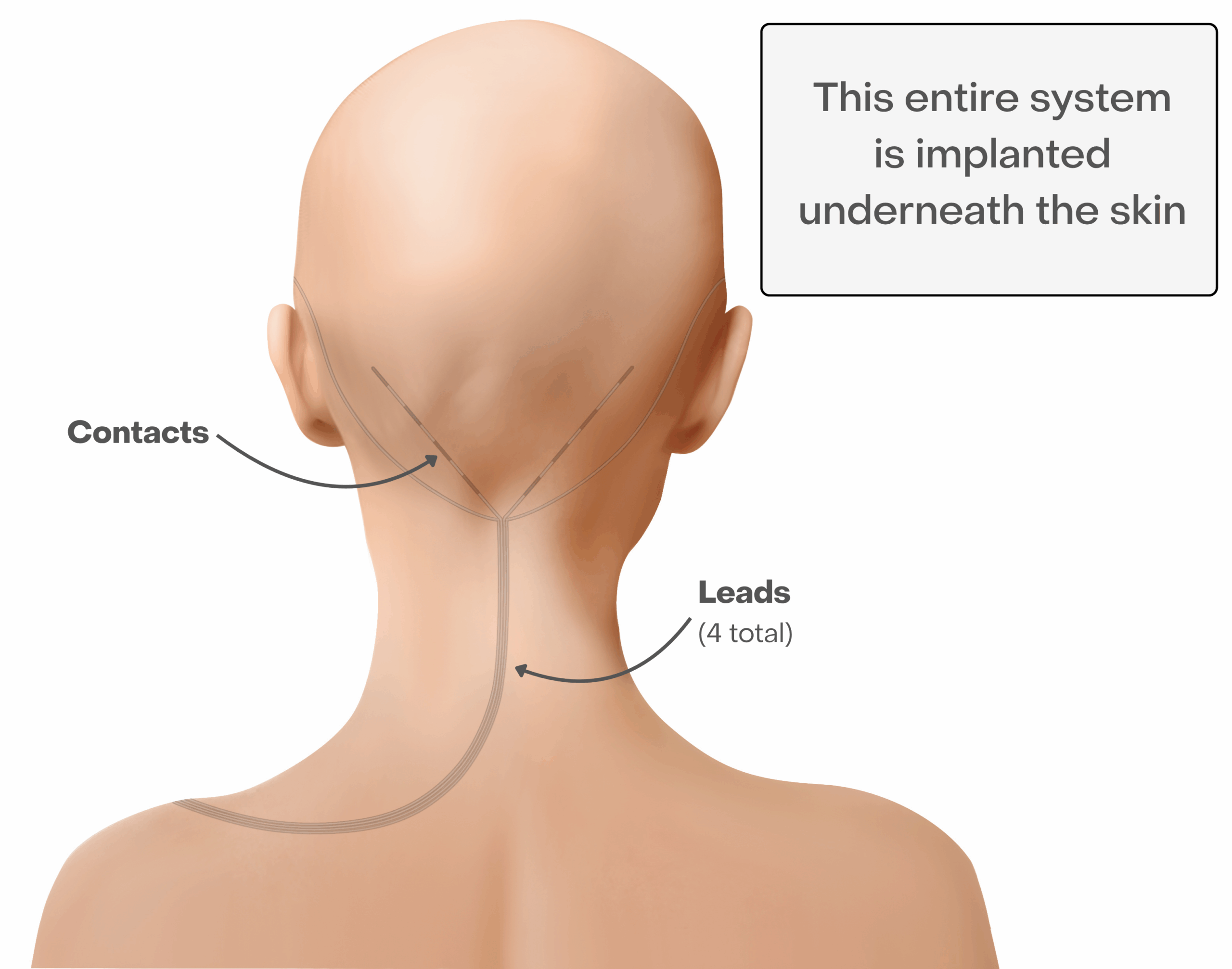 The back view of a patient who has had the permanent procedure.