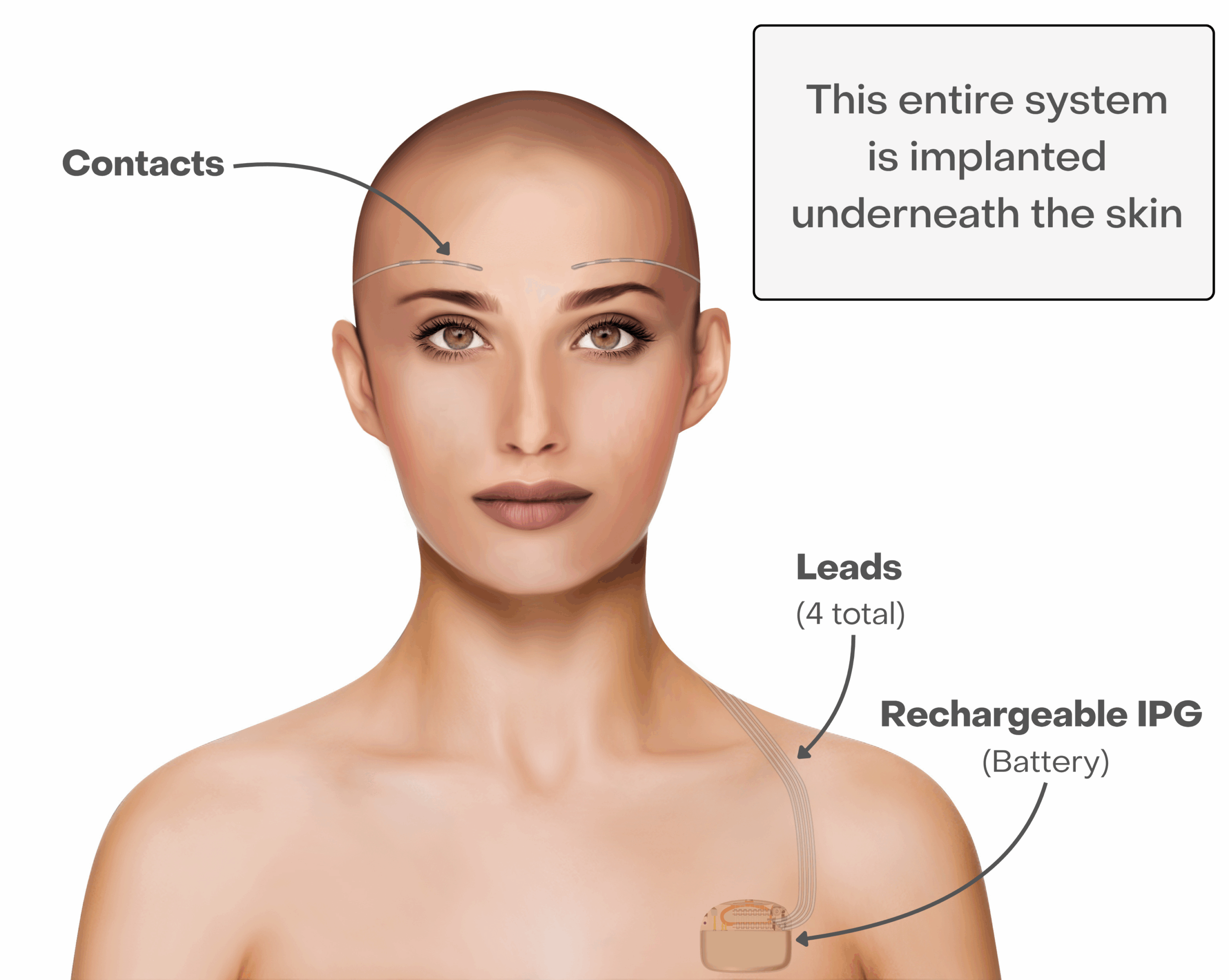 The front view of a patient who has had the permanent procedure.